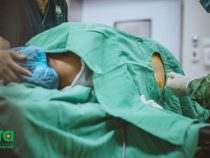 Điều mẹ cần thiết phải biết về gây ra tê ngoài màng cứng