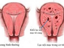 U nang buồng trứng và lạc nội mạc tử cung không tương tự nhau thế nào?