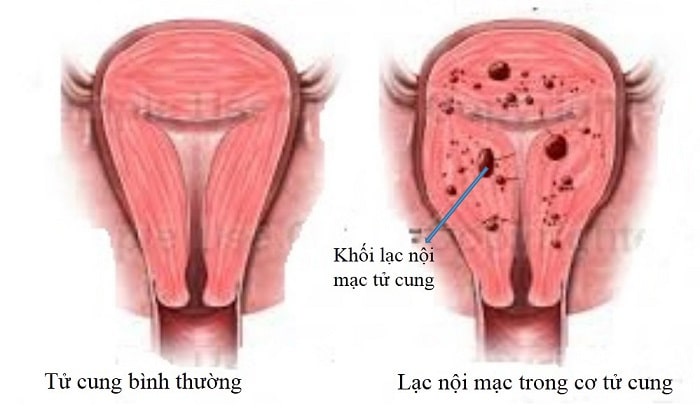 Lạc nội mạc tử cung ở nữ giới