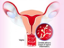 Nấm bộ phận sinh dục nữ mạn tính gây nên ra những tác động gì?