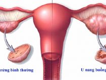 5 Dấu hiệu nhận biết chứng bệnh u nang buồng trứng