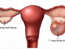 Mổ nội soi u nang buồng trứng như thế nào?