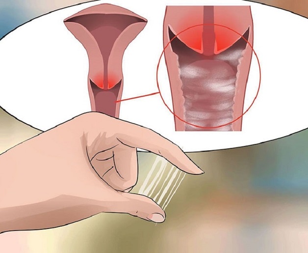 Âm đạo chảy mủ là triệu chứng của viêm lộ tuyến tử cung