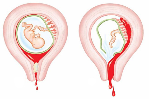 Sau sinh, sản dịch của người phụ nữ sẽ được đẩy ra ngoài dần dần cùng quá trình co hồi của tử cung