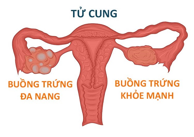 nang đa thùy buồng trứng