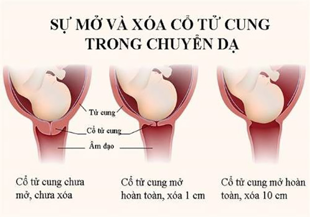 Giai đoạn đầu tiên trong chuyển dạ đẻ thường là xóa mở cổ tử cung, có thể kéo dài trong 15 tiếng