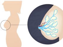 Cách trị tắc tia sữa vón cục hữu hiệu cho mẹ tại nhà