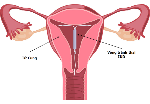 đặt vòng có bị tăng cân không