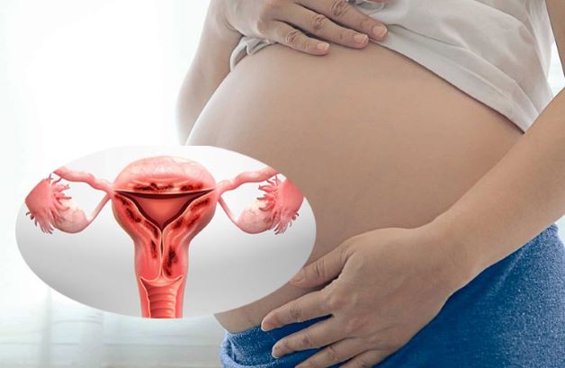 Lạc nội mạc tử cung khi mang thai có thể khiến mẹ gặp nhiều triệu chứng khó chịu trong thai kỳ