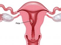 Chớ nên xem nhẹ với chứng bệnh polyp tử cung ở phụ nữ