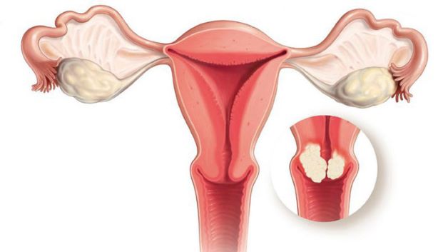Các bất thường liên quan đến tử cung có thể là nguyên nhẫn dẫn đến sự rối loạn chu kỳ kinh nguyệt gây nên hiện tượng rong kinh