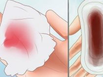 Hiện tượng đặt vòng tránh thai mắc phải ra huyết nâu