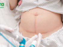 Mẹ đẻ mổ đau đớn mấy ngày? Giữ gìn vết mổ sau sinh ra sao?