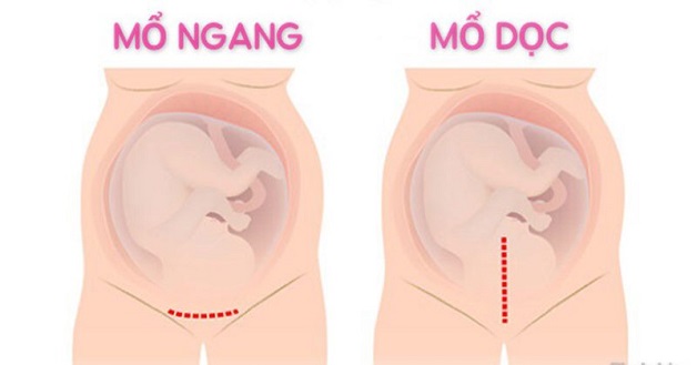 Phương pháp đẻ mổ vết vết rạch ngang thường được ưu tiên lựa chọn vì tính thẩm mỹ cao