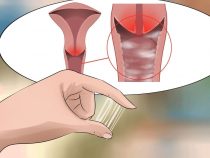 Sau khi đặt vòng mắc phải ra khí hư có nguy hiểm không?