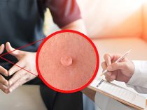 Sùi mào gà lây lan qua những yếu tố nào và những điều cần thiết phải biết