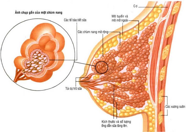 Tắc tia sữa mưng mủ là một cấp độ nặng hơn của tắc tia sữa