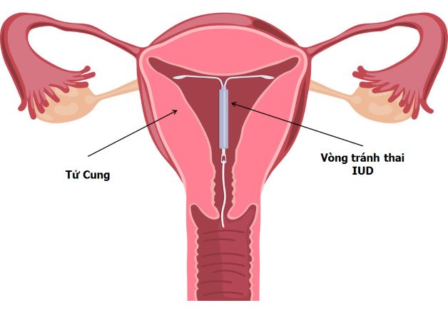 thời điểm đặt vòng tránh thai là bao giờ
