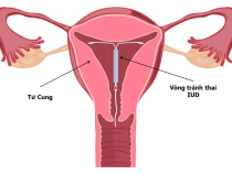 Thế nào là thời điểm đặt vòng tránh thai phù hợp?