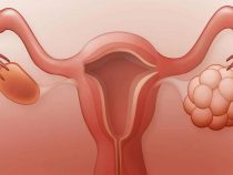 U nang buồng trứng 1 bên có tác động tới sinh sản không?