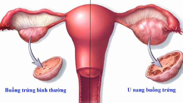 U nang buồng trứng được chia làm 2 dạng là u nang cơ năng và u nang thực thể