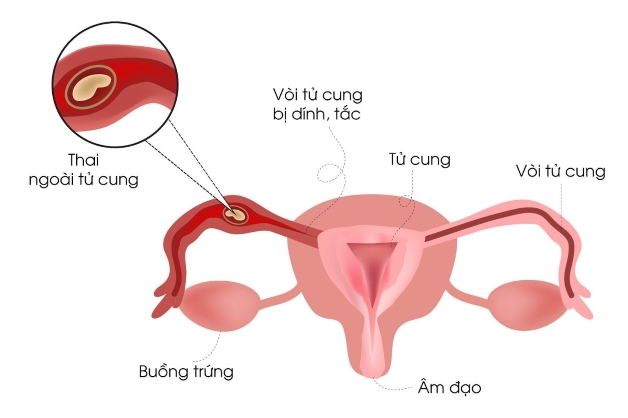 chửa ngoài tử cung thể huyết tụ thành nang là gì