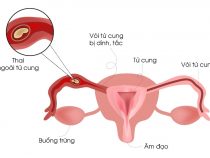 nên lưu ý gì khi có thai lại sau chửa ngoài tử cung?