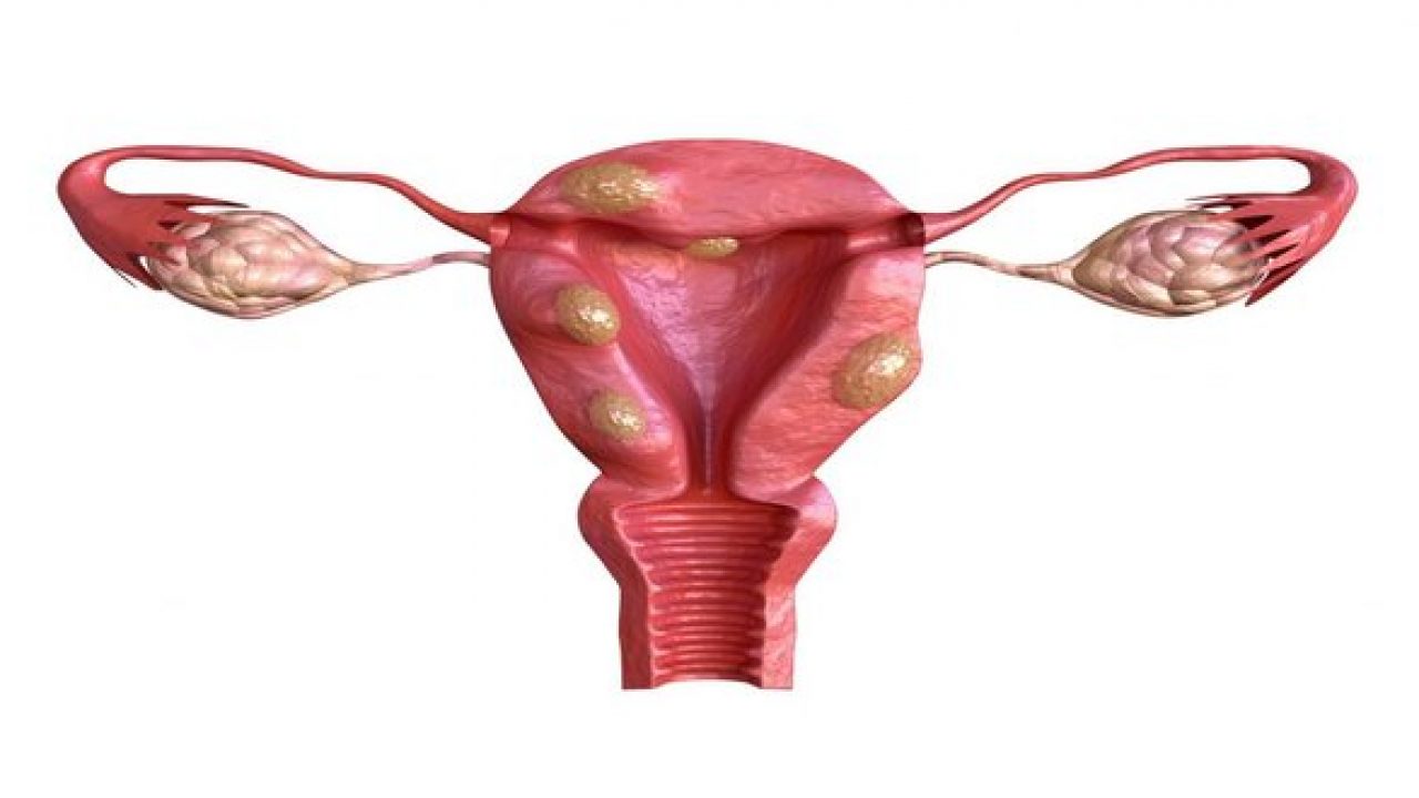 Có tổn thương thực thể ở tử cung, buồng trứng là nguyên nhân dẫn đến rối loạn kinh nguyệt