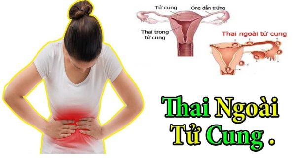 làm gì khi chửa ngoài tử cung ở phụ nữ