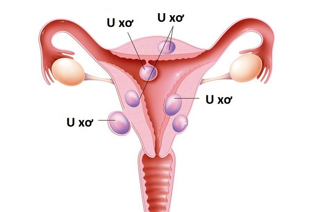 U xơ tử cung có kích thước từ vài milimet đến vài centimet