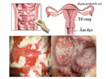 [ Viêm bộ phận sinh dục nữ ] là căn bệnh gì ? Nguyên nhân, triệu chứng và cách chữa trị căn bệnh hữu hiệu hiện nay
