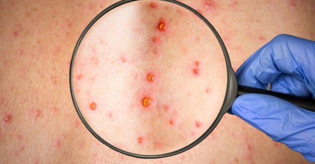 các triệu chứng bệnh giang mai thường gặp