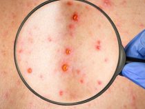 Các triệu chứng căn căn bệnh giang mai theo thời kỳ như thế nào?