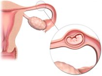 Chửa ngoài tử cung gặp phải vỡ – Tai nạn sản khoa nguy hiểm chị em cần phải lưu ý