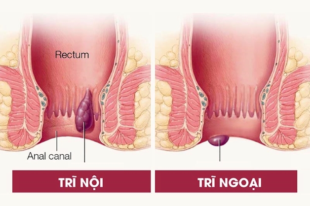 đẻ thường xong bị trĩ