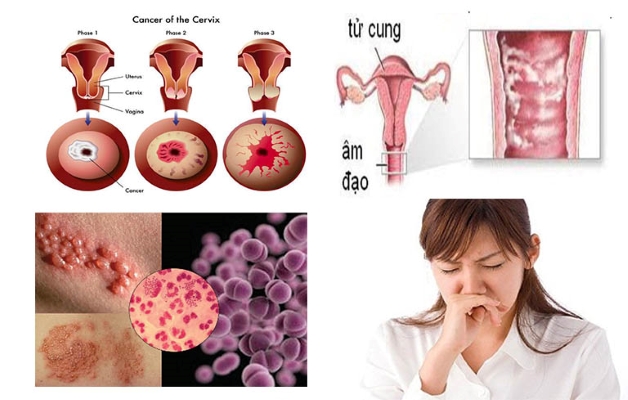 Hiện tượng rong kinh có mùi hôi báo động các bệnh lý