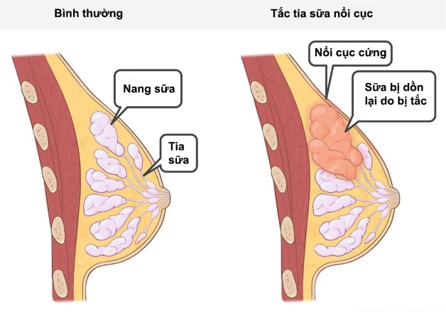 tắc tia sữa làm thế nào