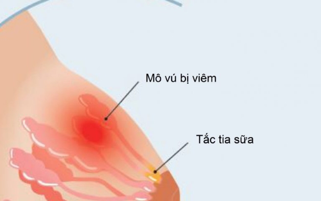 tắc tia sữa sốt rét