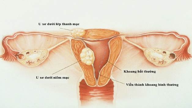 Vì sao u xơ tử cung gây rong kinh - Bệnh lý u xơ tử cung là một bệnh lý thường hay gặp ở phụ nữ