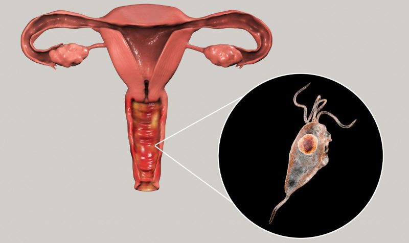 Viêm âm đạo do Trichomonas gây ra những triệu chứng ngứa rát, tấy đỏ ở khu vực sinh dục