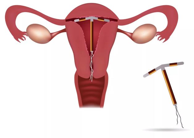 Đặt vòng tránh thai có tác dụng ngừa thai lên đến 99% và có thể kéo dài tác dụng ngừa thai lên tới 5 năm