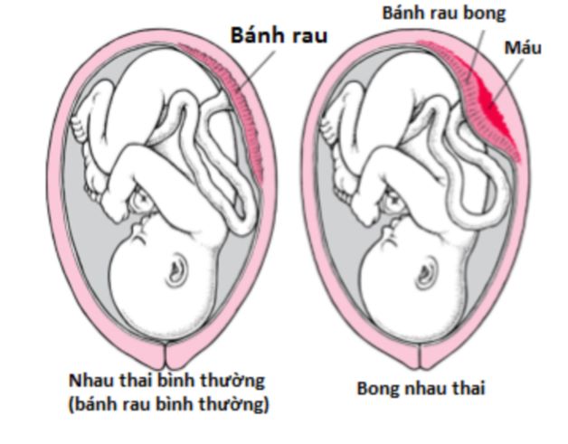 Đẻ mổ có bị sót rau không - Tử cung không tống đẩy hết toàn bộ nhau mà vẫn còn sót lại một chút trong tử cung được gọi là tình trạng sót nhau (sót rau) sau sinh.