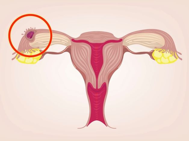Hình ảnh miêu tả hiện tượng chửa ngoài tử cung