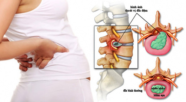 Tình trạng thoát vị đĩa đệm khi mang thai khiến các mẹ bầu khá "vất vả"