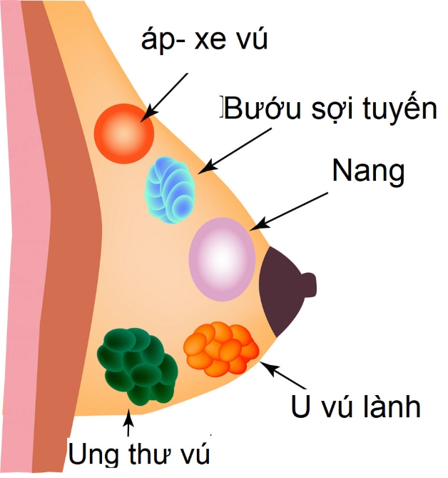 tắc tia sữa gây áp xe - Hiện tượng áp xe vú ở mẹ sau sinh thường có 3 giai đoạn: ổ viêm, áp xe, hoại tử.
