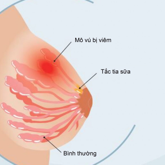 Tắc tia sữa gây áp xe - Thông thường, thời gian để mẹ bị tắc tia sữa gây ra áp xe vú là khoảng 4 tuần