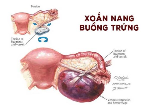 Xoắn u nang buồng trứng