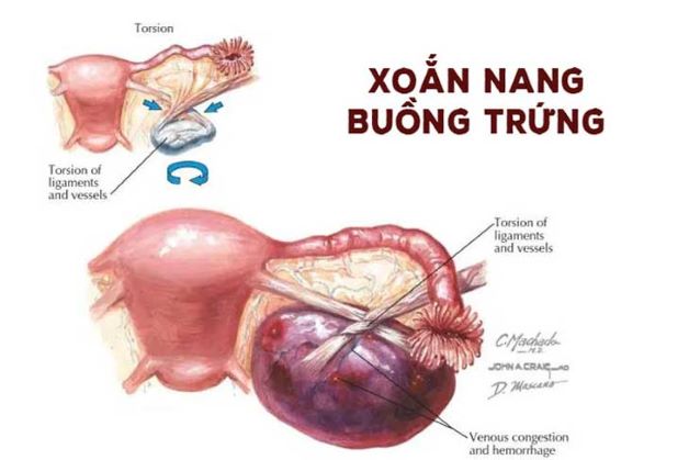 Xoắn u nang buồng trứng