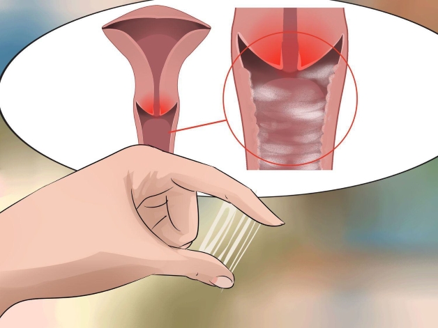 Biểu hiện rõ nhất khi mắc bệnh viêm âm đạo do trùng roi này là khí hư của âm đạo tiết ra nhiều hơn, chất loãng hơn bình thường, đôi khi còn có bọt.