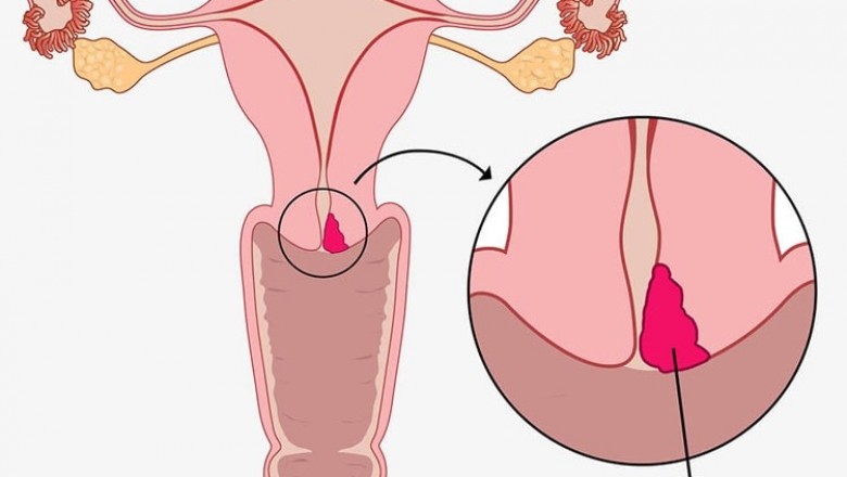 Khí hư màu hồng nhạt có thể là biểu hiện của bệnh ung thư cổ tử cung